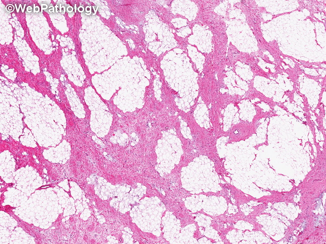 Soft Tissue_Lipomatous_Lipoblastoma28_resized.jpg
